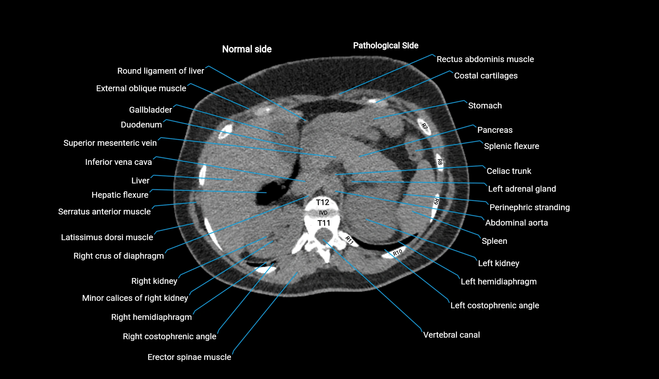 CT KUB axial cross sectional anatomy  radiology image -img-00201-00023.webp